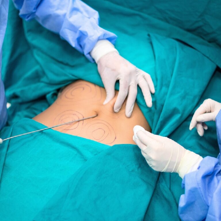 Liposuction vs. Non-Surgical Fat Reduction in Singapore